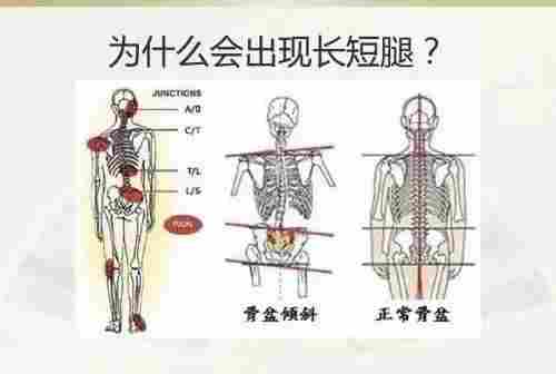 骨盆侧倾长短腿应怎样矫正？